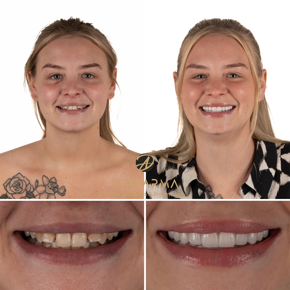 Kelsey-SmileMakeover1
